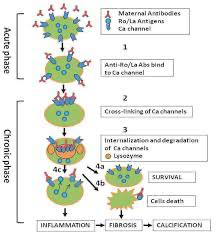 Physiopathologie du BAV immun congénital