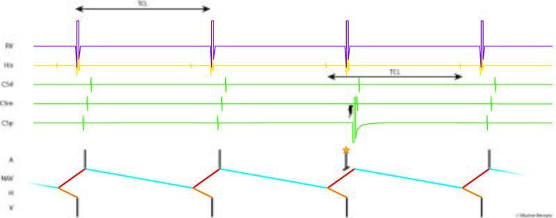 Fichier:Figure 21 - Late PAC.jpg