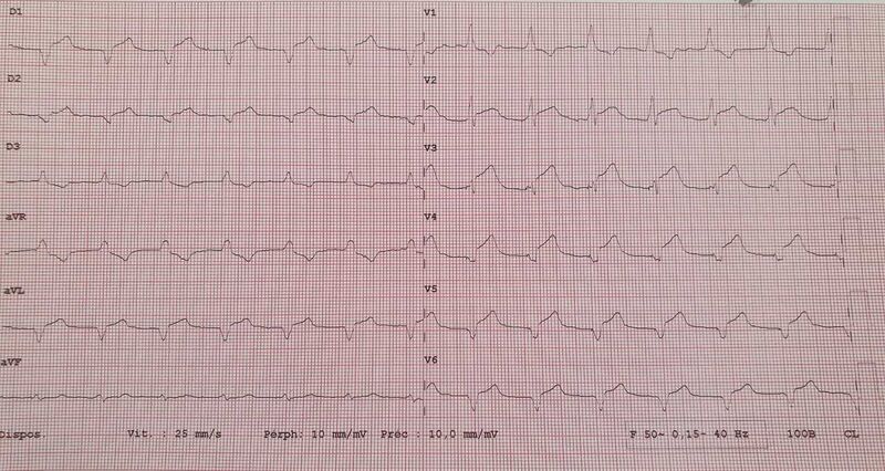 Fichier:ECG après implantation d'un stimulateur biventriculaire.jpg