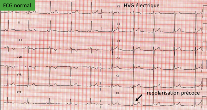 ECG2.png