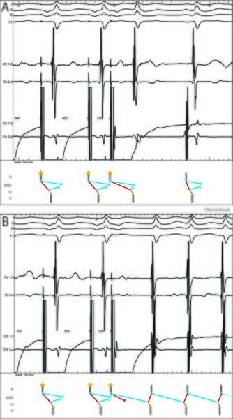 Fichier:Figure 11 - Saut écho démarrage.jpg