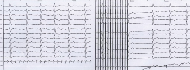 Réduction d'un flutter atrial par Overdrive au moyen d'une sonde oesophagienne.png