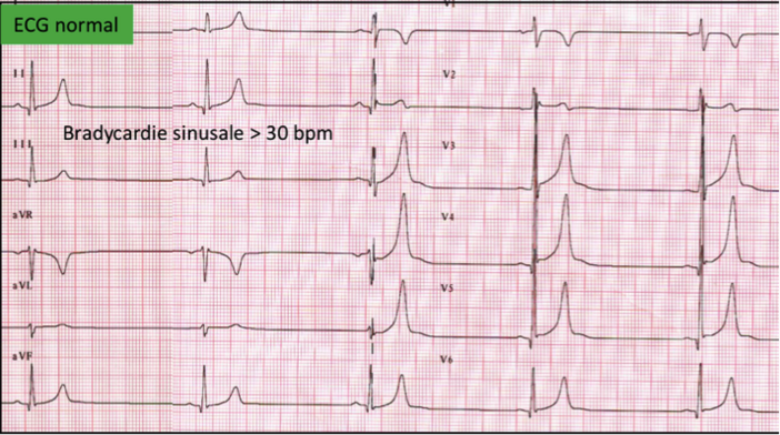 ECG1.png