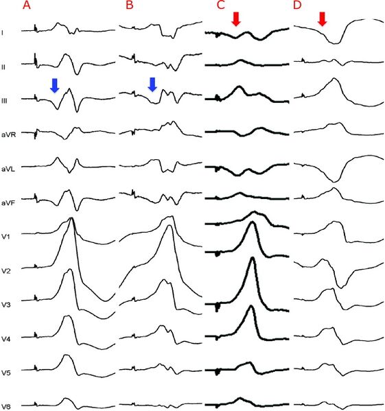 Fichier:TV épicardique vs TV endocardique.jpg