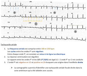 Tachycardie atriale — Uness Cardiologie