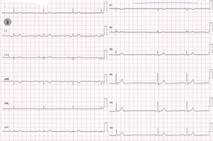 Maladie rythmique de l'oreillette ECG 3.png