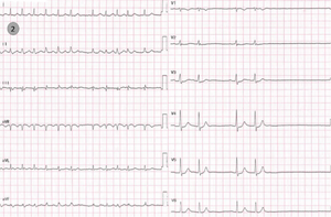 Maladie rythmique de l'oreillette ECG 2.png