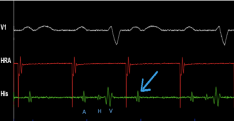 Baie d'électrophysiologie montrant un Bloc supra-hissien.png