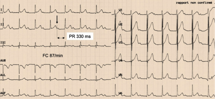 BAV1 < 400ms.