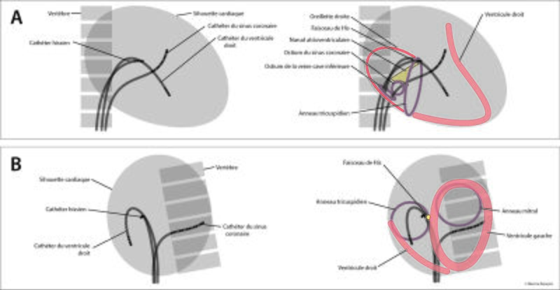 Fichier:Figure 8 - Cathéters et anatomie.jpg