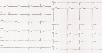 Rythme du sinus coronaire.