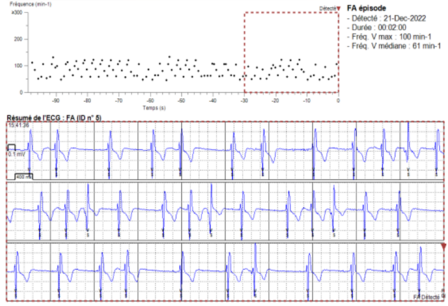 Episode de FA enregistré sur un moniteur cardiaque implantable et vu en télécardiologie.png
