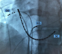 Vue en scopie de face du postionnement des sondes d'électrophysiologie.png