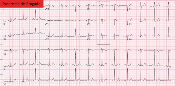 Aspect de Brugada de type I.