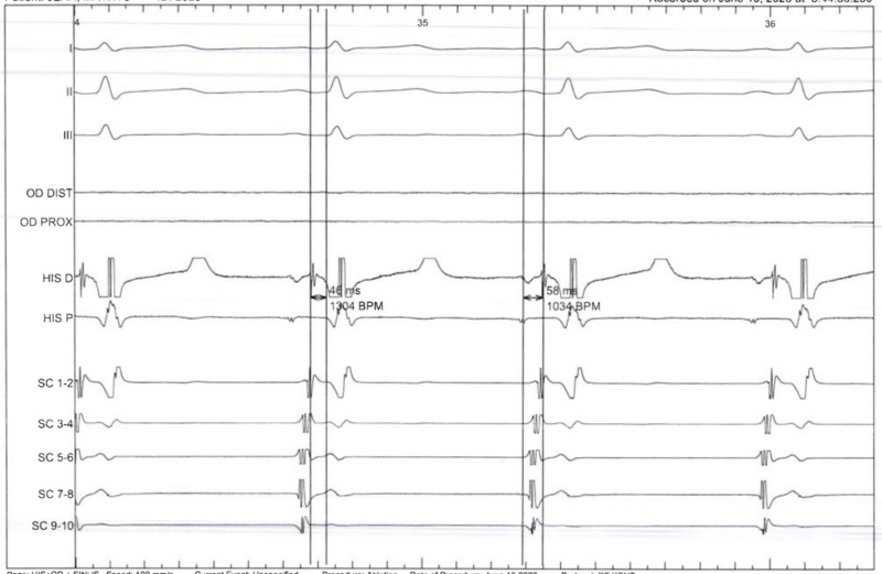 Fichier:Exemple de tracé endocavitaire sur baie d'électrophysiologie.png