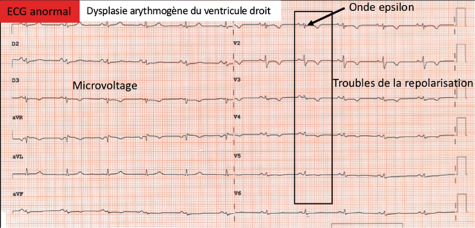 Aspect compatible avec dysplasie arythmogène du ventricule droit.