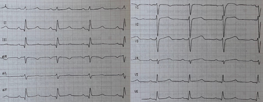 Onde Q — Uness Cardiologie