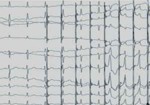 Stimulation atriale décrémentielle avec passage exclusif par une voie accessoire.png