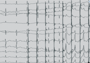 Stimulation atriale décrémentielle avec passage exclusif par une voie accessoire.png