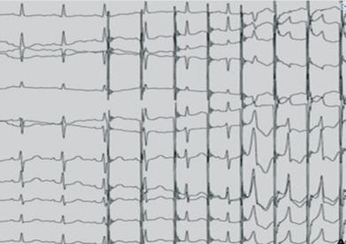 Stimulation atriale décrémentielle avec passage exclusif par une voie accessoire.png