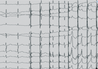 Stimulation atriale décrémentielle avec passage exclusif par une voie accessoire.png