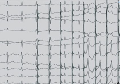 Stimulation atriale décrémentielle avec passage exclusif par une voie accessoire.png