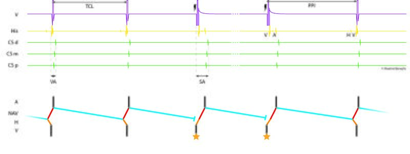 Fichier:Figure 15 - Entraînement ventriculaire.jpg
