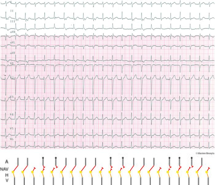 Fichier:Figure 1 - JET dissociation rétro.jpg