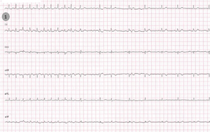 Maladie rythmique de l'oreillette (ECG 1).png