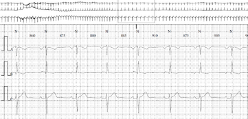 Exemple d'enregistrement d'un Holter ECG conventionnel.png