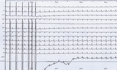 Déclenchement d'une TRIN par extrastimulus atrial.png