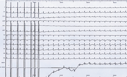 Déclenchement d'une TRIN par extrastimulus atrial.png