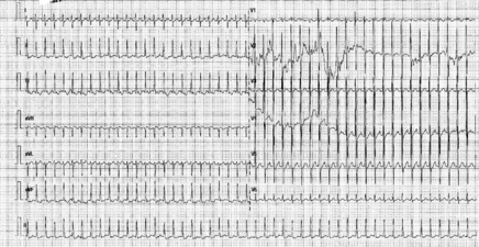 Tachycardie jonctionnelle chez un nouveau-né