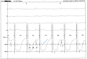 Stimulation atriale décrémentielle avec bloc en 2-1 supra Hissien.png