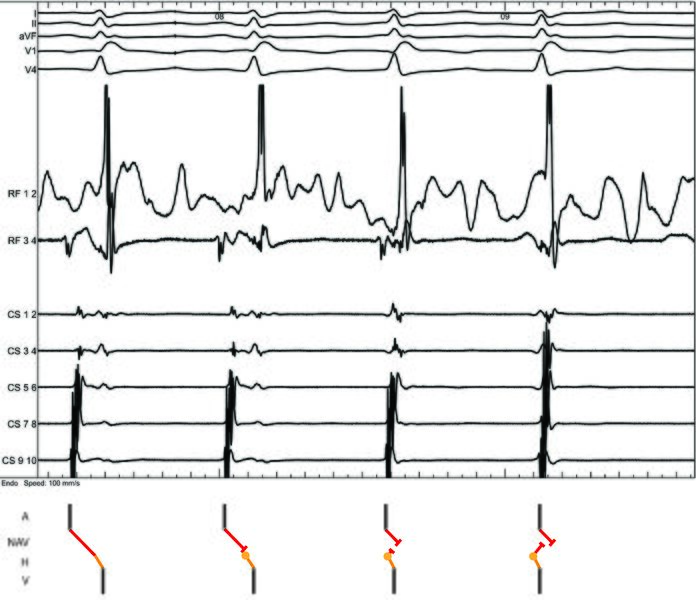 Fichier:FIgure 25 - Junctional during ablation.jpg