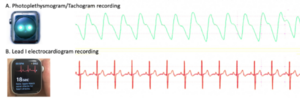 Tracé pléthysmographique et ECG monopiste d'une montre connectée.png